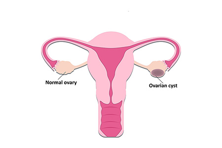 Ovarian Cyst